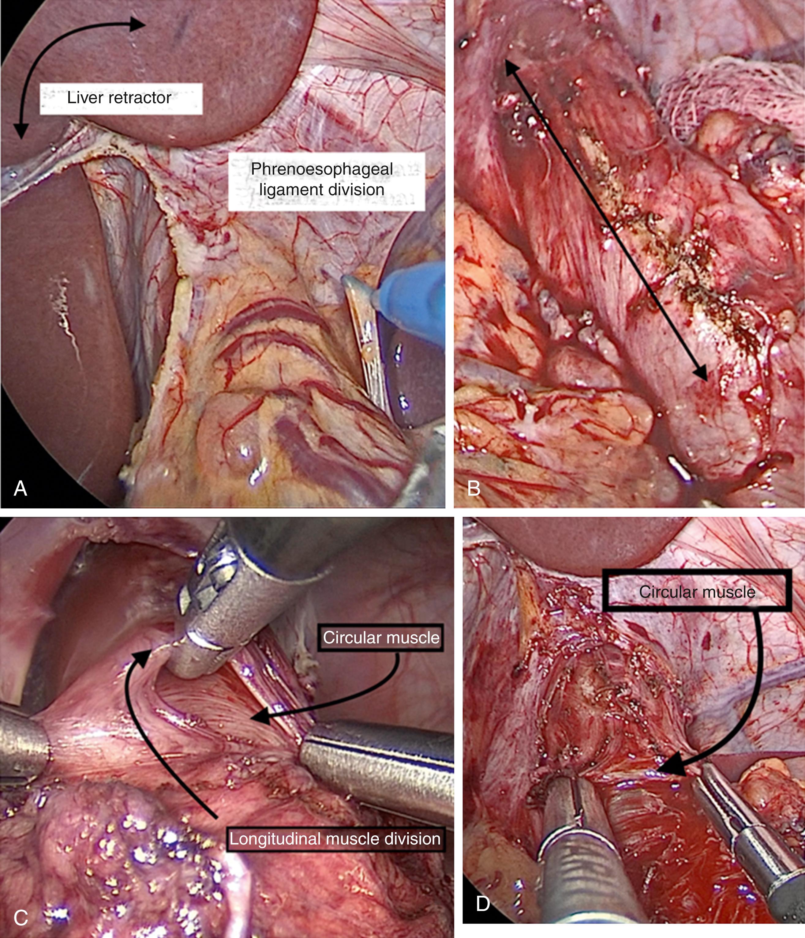 Fig. 3-3, A, The lower esophagus has been exposed. B, The planned myotomy is marked with cautery. C, The longitudinal muscle layer is being divided. D, The circular muscle layer is about to be divided.