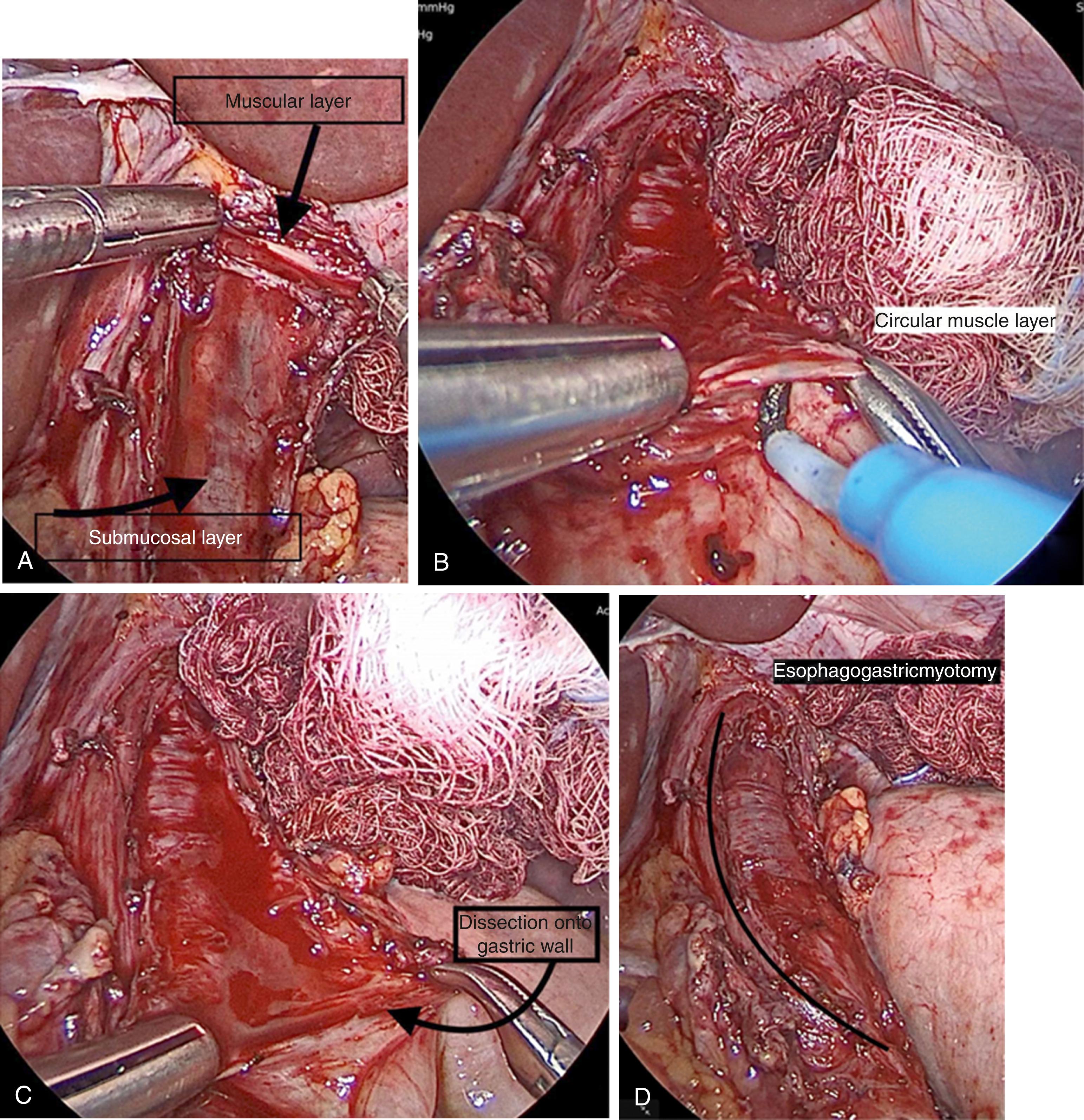 Fig. 3-4, A, The submucosal is seen after division of the longitudinal muscle layer. B, The hook electrocautery is being used to divide the circular muscles of the esophagogastric junction (ECJ). C, The myotomy is now being extended through the gastric muscles. D, The completed esophagomyotomy is seen.