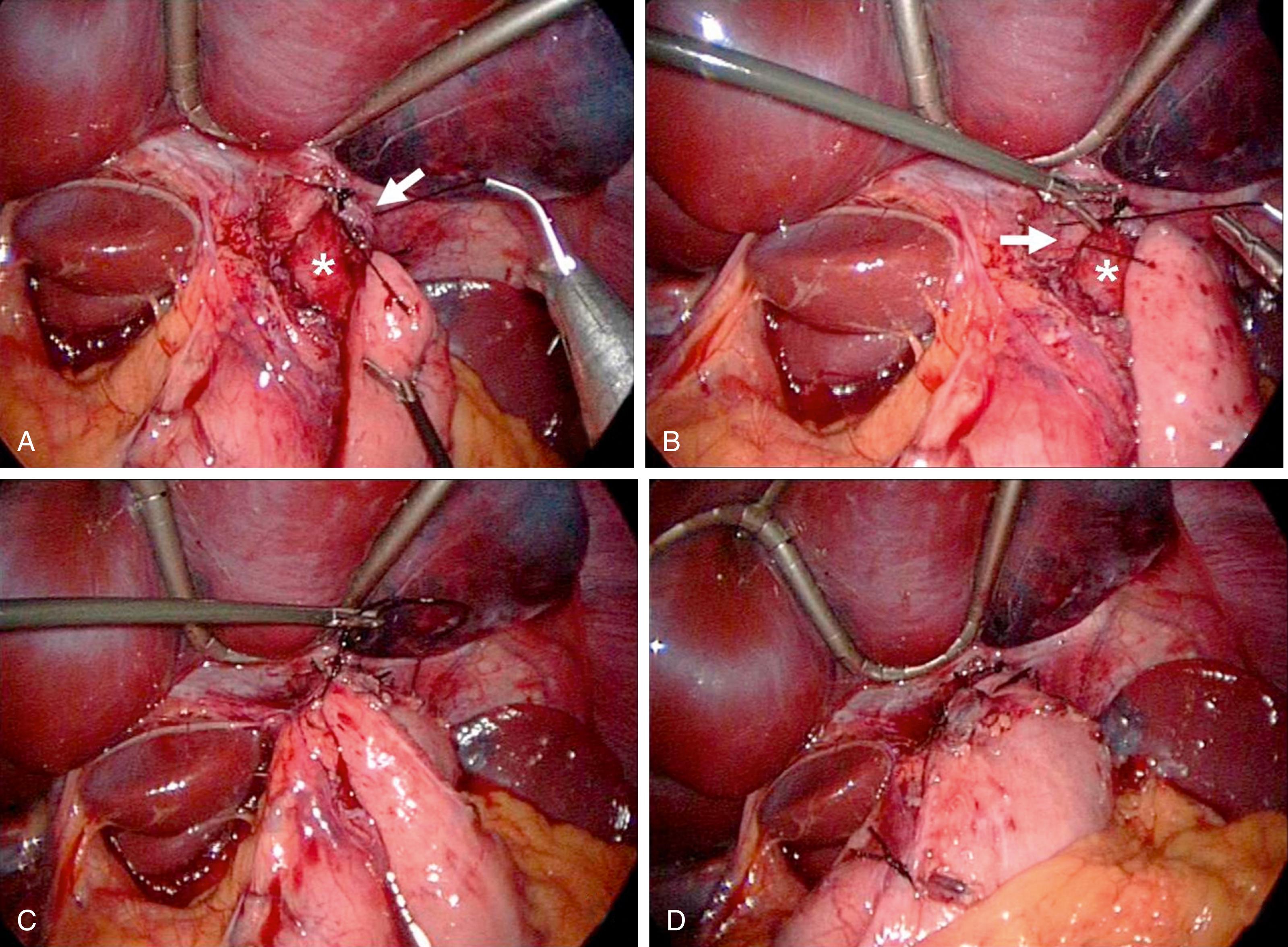 Fig. 3-5, A Dor fundoplication has been performed following the esophagomyotomy. The anterior portion of the stomach is initially fixed to the muscular edge of the myotomy ( arrow ) and crus on the patient’s left side ( A ). It is then secured to the muscular edge of the myotomy and crus ( arrow ) on the right side ( B ). In both A and B, the submucosa of the esophagus has been marked with an asterisk. The anterior stomach is then secured to the lateral portion of the patient’s right crus to keep it in an anterior position ( C ). Finally, the anterior stomach is sutured to the right border of the stomach to take tension off the other sutures ( D ).