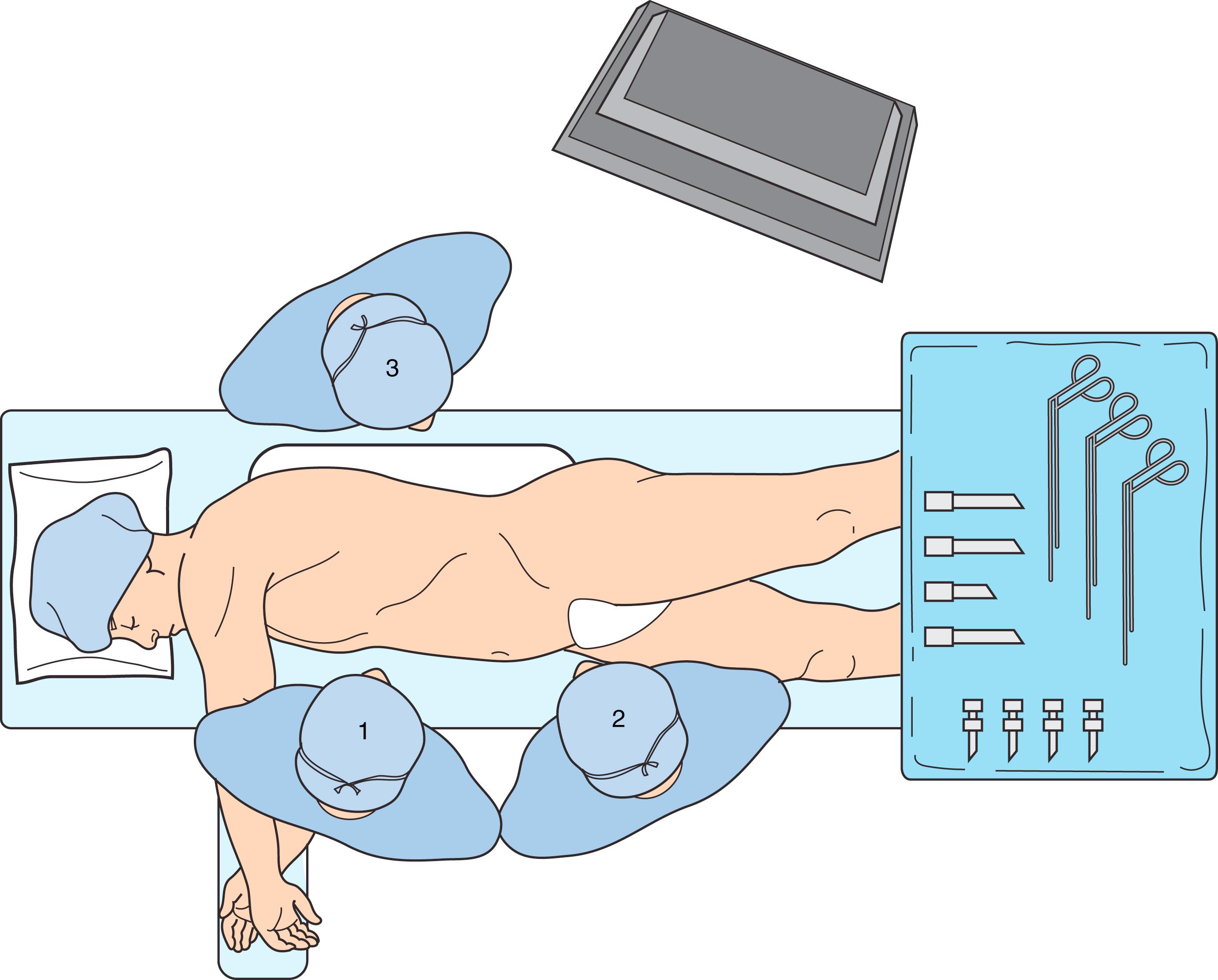 Figure 64.1, Patient in right lateral decubitus position for a total laparoscopic retrocolic transperitoneal approach. 1 , operating surgeon; 2 , first assistant; 3 , second assistant.