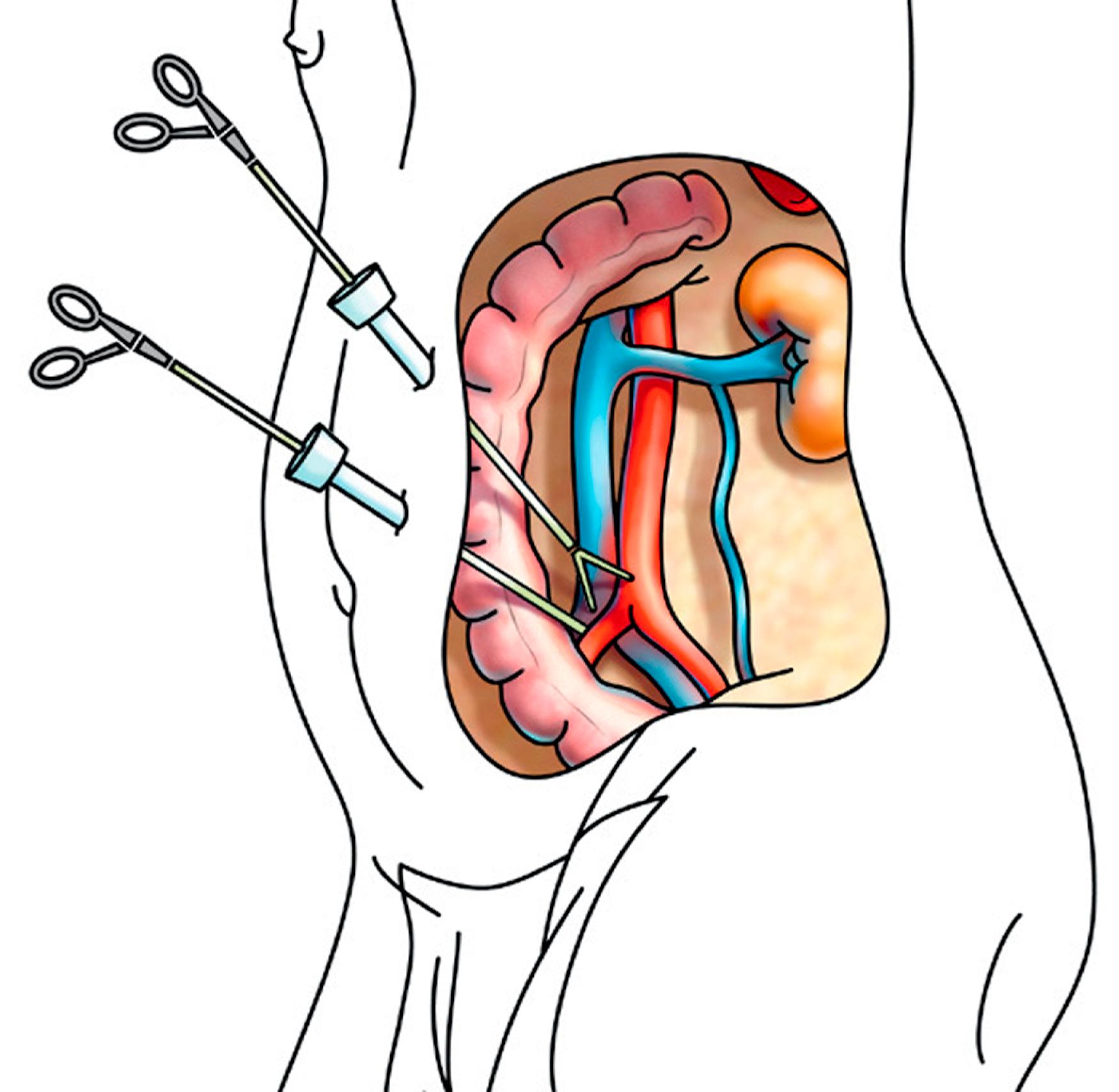 Figure 64.3, Aortic exposure through a left retrocolic prerenal approach. The patient is in right lateral decubitus. The intestinal loops collect on the right side of the abdomen with the mesocolon forming an apron. This technique provides a stable exposure of the aorta.