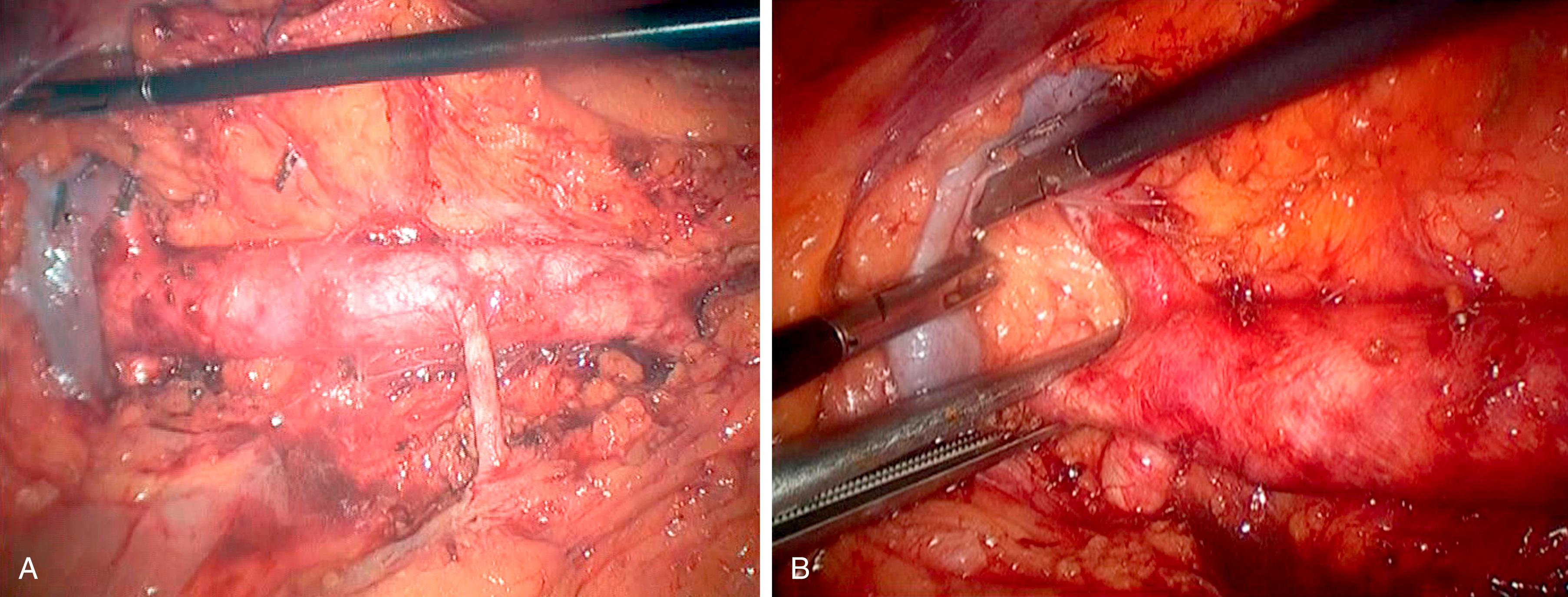 Figure 64.4, ( A ) Complete exposure of the aorta, iliac arteries and inferior mesenteric artery through a left retrocolic prerenal approach. ( B ) Cross-clamping of the suprarenal aorta for extensive occlusive disease and calcification of the infrarenal aorta (same approach).