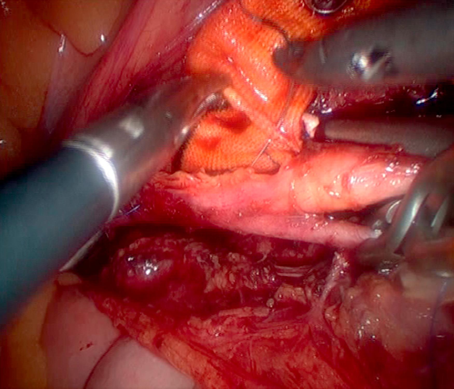 Figure 64.6, End-to-side totally laparoscopic aortic anastomosis with a 3/0 polypropylene running suture using curved jaws and axial handle needle holder.
