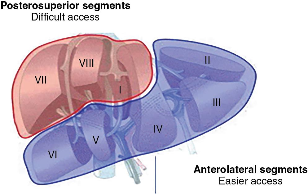 FIGURE 127E.1, Easy locations: segments II to VI (favorable because facing the scope). Difficult locations: segments I, IVa, VII and VIII (difficulty related to access and proximity of hepatic veins and IVC).