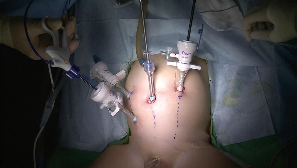 Fig. 14-6, This operative photograph shows our preferred port sites for the laparoscopic pull-through.