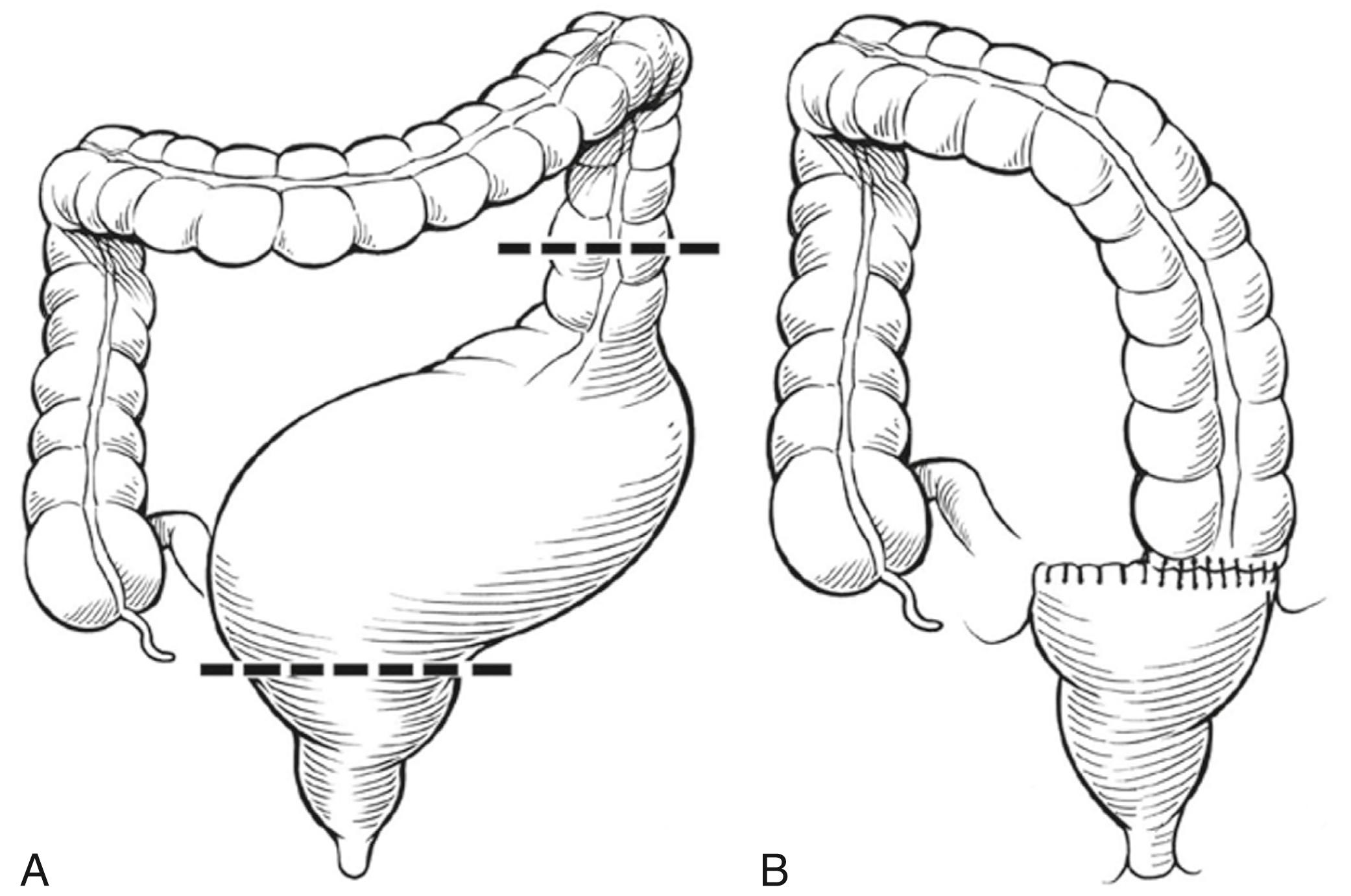 Fig. 11-1, A , Patients who have undergone an operation for the types of anorectal malformation with a good prognosis often suffer from varying degrees of hypomotility and dilation of the rectum and sigmoid colon. B , If medical treatment is not effective because the child has a huge megasigmoid colon and requires an enormous amount of laxative to empty it, the surgeon can offer an operation to resect the dilated sigmoid colon.