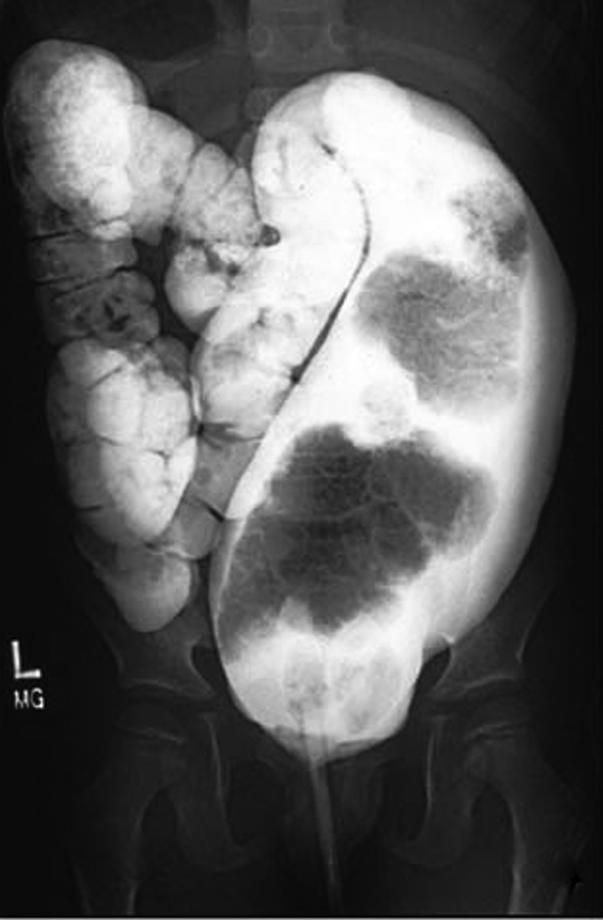 Fig. 11-2, For a patient who has not had reconstructive surgery but suffers from severe constipation, a water-soluble contrast study is helpful. The characteristic image is a megarectosigmoid colon with dilation of the colon all the way down to the level of the levator mechanism. (This is in contrast to the transition zone seen in patients with Hirschsprung disease, where there is usually a dramatic size discrepancy between the normal descending colon and the dilated megarectosigmoid.)