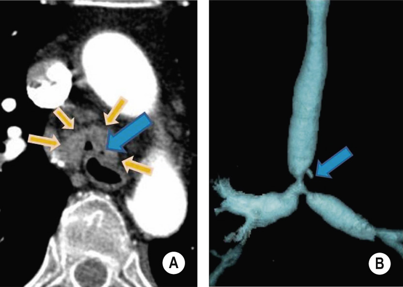 Infectious tracheobronchitis. (A) Severe stenosis of the distal trachea (orange arrows) and proximal main bronchi associated with a fistulous tract (blue arrow) connecting with a paratracheal submucosal abscess. (B) 3-D reconstruction. **