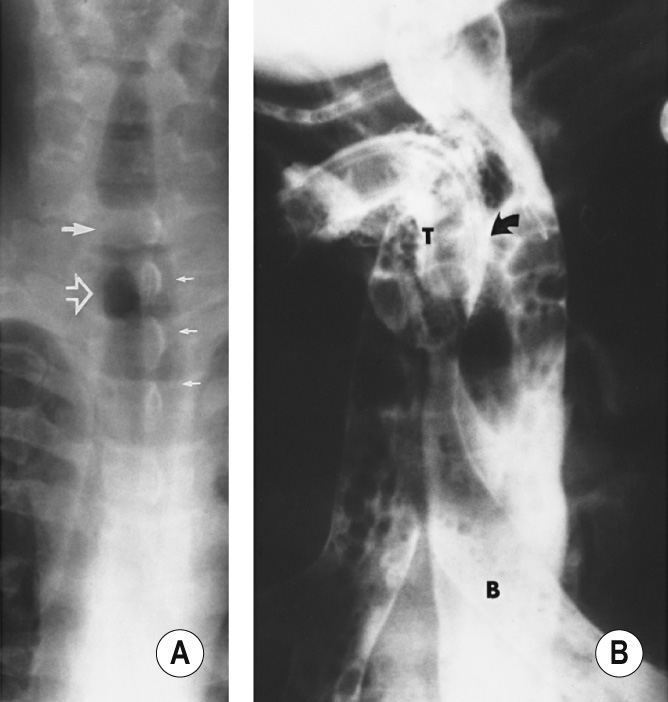 Tracheo-oesophageal fistula following prolonged intubation and an indwelling NGT. (A) PA XR of the trachea reveals a tracheal stenosis (arrow) proximal to a tracheostomy stoma (open arrow). The proximal oesophagus is distended with air (arrows) close to the fistula. (B) A contrast study demonstrates filling of the fistula (arrow) and aspiration of contrast medium from the oesophagus (O) into the trachea (T) and main bronchi (B). ‡