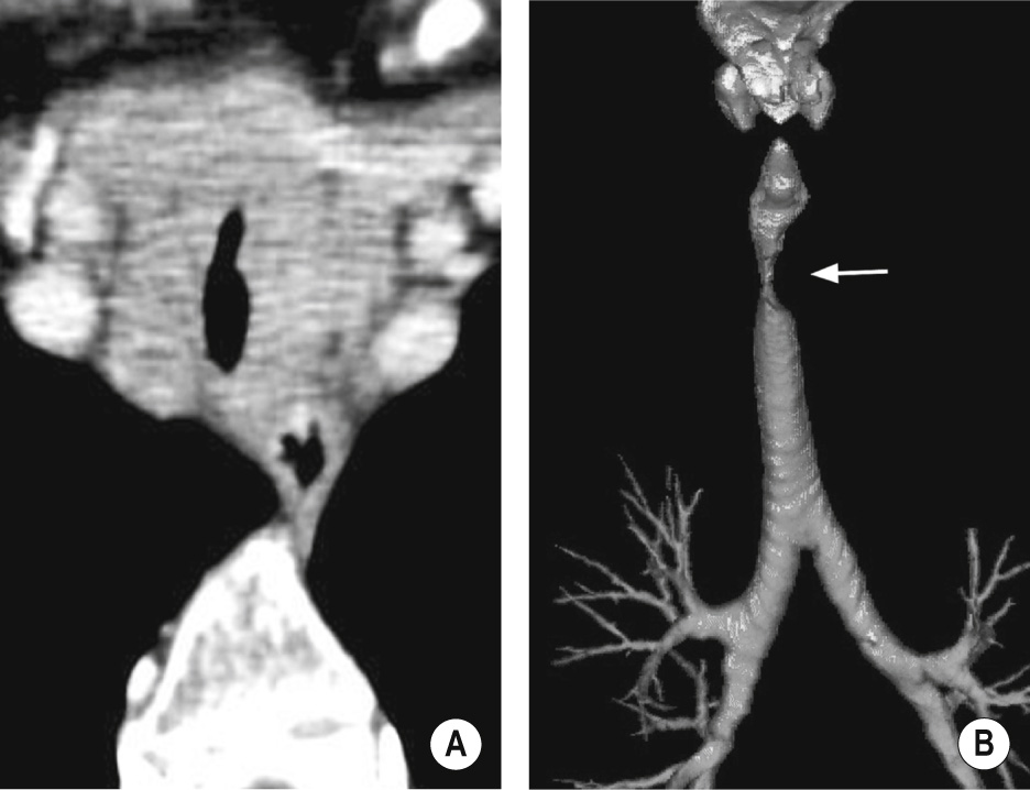 Adenoid cystic carcinoma of the trachea. (A) Axial CT at the level of the supra-aortic part of the mediastinum. Irregular stenosis of the tracheal lumen due to a soft tissue mass developing from the posterior and left lateral wall of the trachea. (B) Coronal 3D external volume rendering. The level, length and degree of the tracheal lumen involvement (arrow) is accurately assessed. *