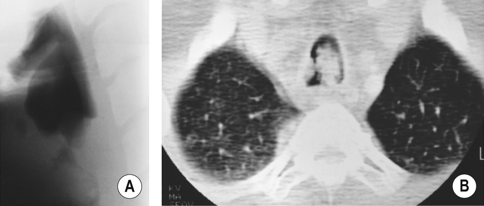 Diffuse tracheobronchial papillomatosis. (A) Lateral soft tissue view of the neck reveals nodular masses in the larynx and proximal trachea representing multiple papillomas. (B) CT reveals near obstruction of the tracheal lumen by irregular polypoid masses. ‡