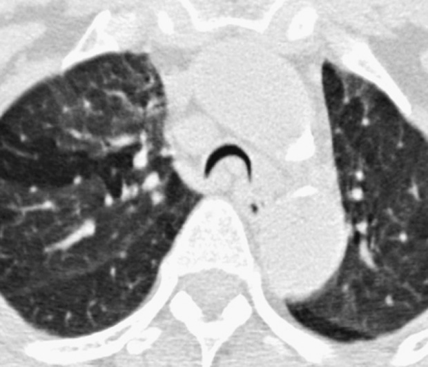 Tracheobronchomalacia. Axial CT acquired during a dynamic expiratory manoeuvre. The collapse of the tracheal lumen is almost complete. The tracheal lumen is crescentic in shape because of the bowing of the posterior membranous trachea. *