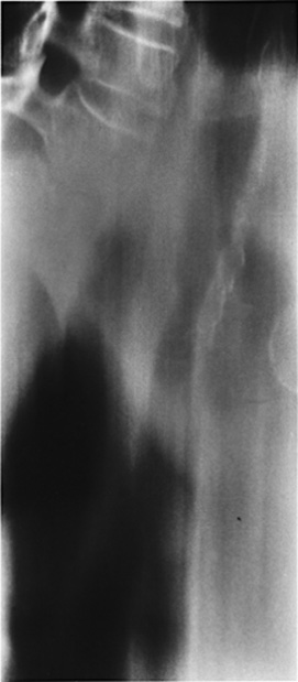 An oblique tracheal tomogram reveals an hourglass stenosis of the mid trachea, representing changes of Wegener's granulomatosis. ‡