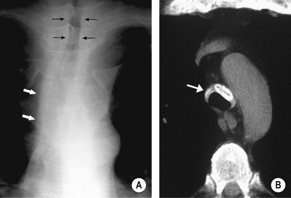 Relapsing polychondritis. (A) PA CXR demonstrating narrowing of the upper tracheal lumen (black arrows). The right paratracheal band is abnormally thickened (white arrows). (B) Axial CT showing abnormal thickening of the anterior and lateral walls of the trachea associated with calcium deposits (arrow). The posterior membranous wall of the trachea is unaffected. *