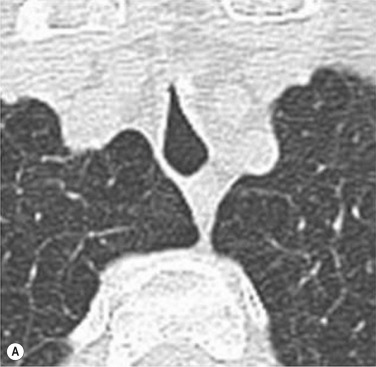 Fig. 6.1, Post Intubation Tracheal Stenosis in a Severe Chronic Obstructive Pulmonary Disease Patient.