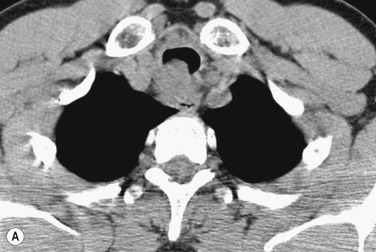 Fig. 6.3, Adenoid Cystic Carcinoma of the Trachea.