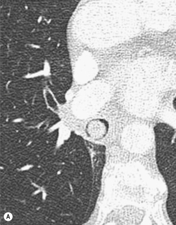 Fig. 6.4, Atypical Carcinoid Tumour of the Intermediate Trunk.