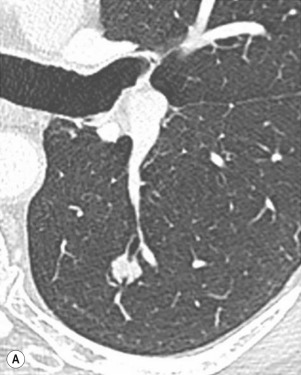 Fig. 6.5, Endobronchial Metastasis.