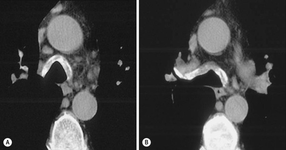 Fig. 6.6, Relapsing polychondritis (A and B). Axial computed tomography images at the levels of the distal part of the trachea and mainstem bronchi. Abnormal thickening of the anterior and lateral walls of the trachea and mainstem bronchi and right upper lobar bronchus associated with calcium deposits. The posterior membranous wall of the trachea is unaffected.