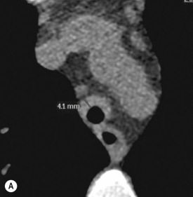 Fig. 6.7, Late Stage Relapsing Polychondritis.