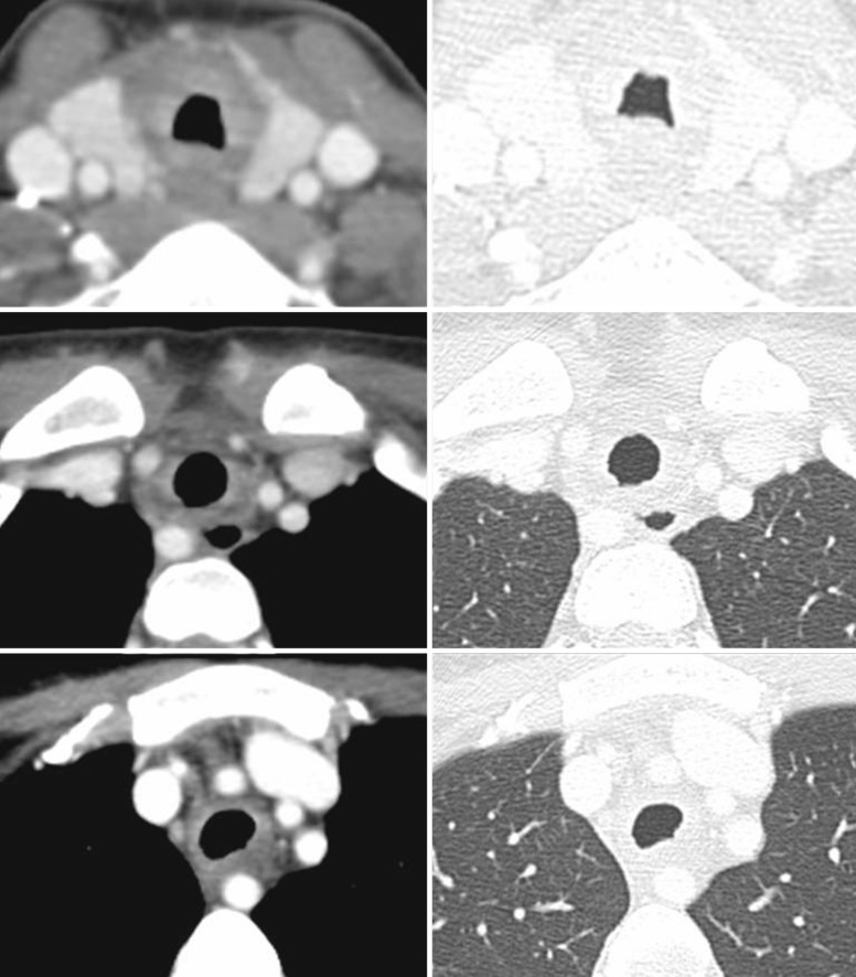 Fig. 6.8, Tracheal Involvement in Crohn Disease.