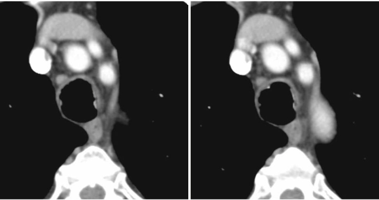 Fig. 6.9, Tracheopathy Osteochondroplastica.