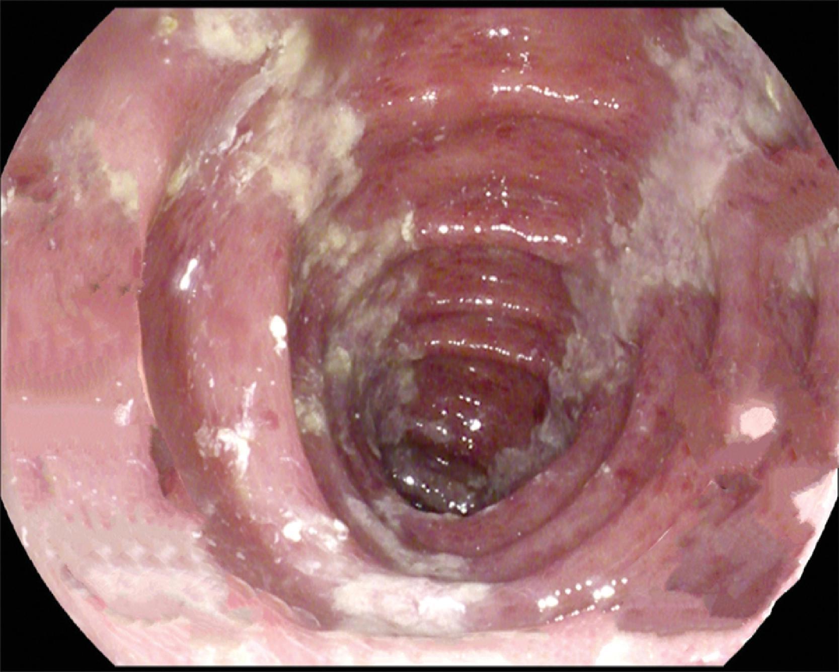 FIG. 4, Colonoscopic image of linear ulcerations placed along the longitudinal axis of the colon.