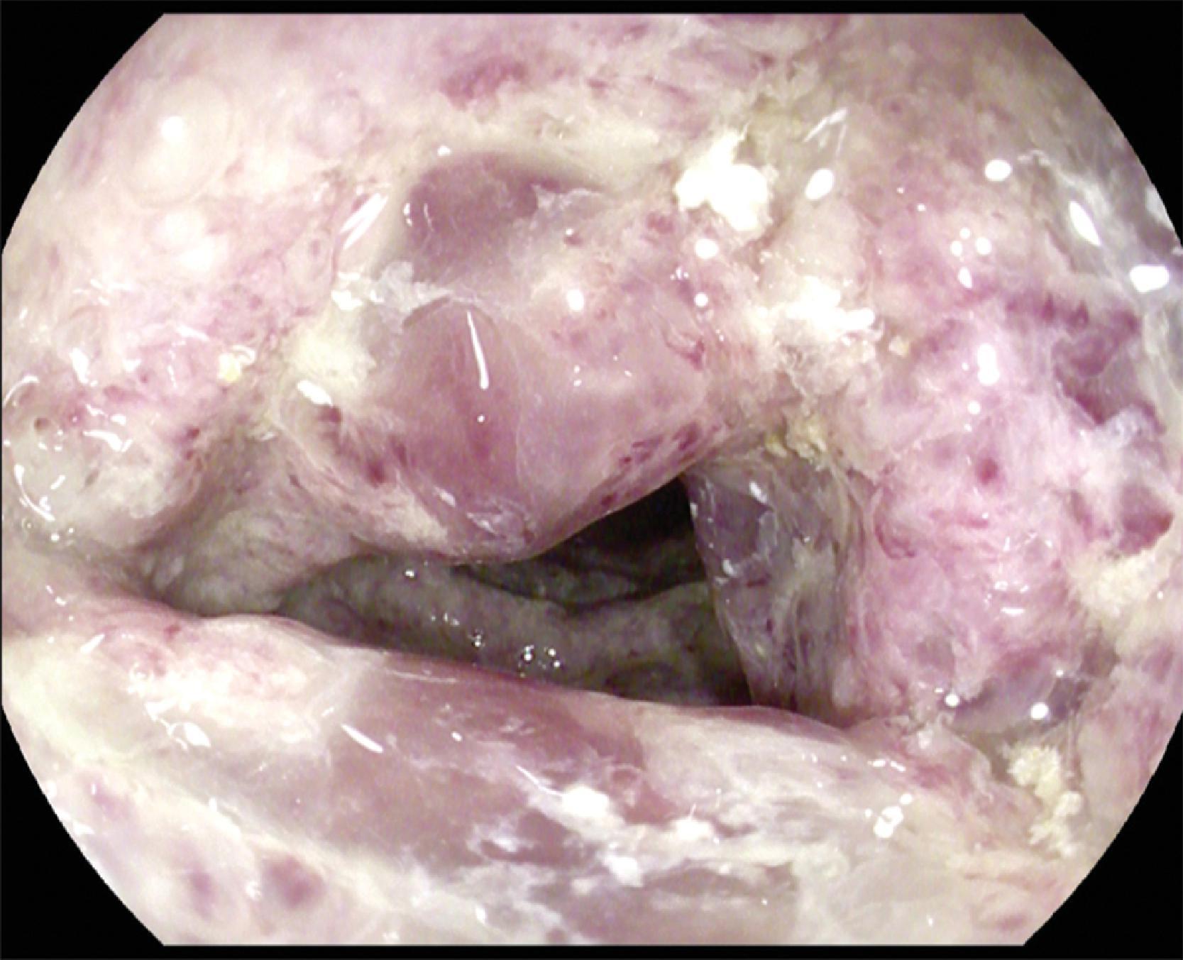 FIG. 5, Colonoscopic image showing cyanotic/black mucosal nodules with deep ulcerations until mucosal necrosis.