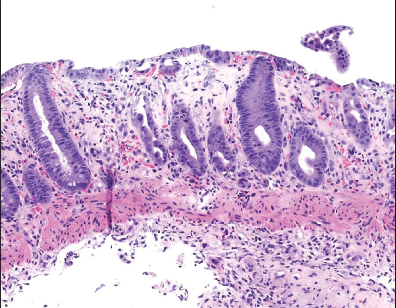 FIG. 6, Ischemic colitis, H&E, 100×. This image shows characteristic features of ischemic colitis, including superficial epithelial injury, crypts with atypia including nuclear hyperchromasia, and hyalinized lamina propria. The crypts appear closer together due to lamina propria collapse.