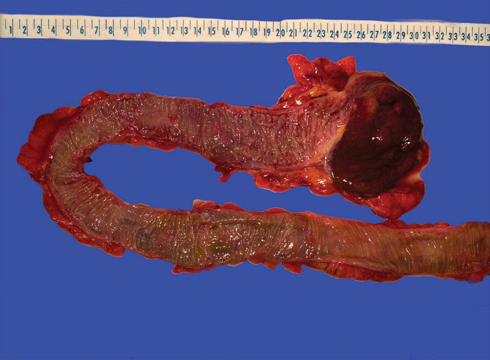 FIG. 7, Portion of intestine with ischemia (cecum, top right of image ). Compare with normal pink-tan mucosa (bottom right of image).