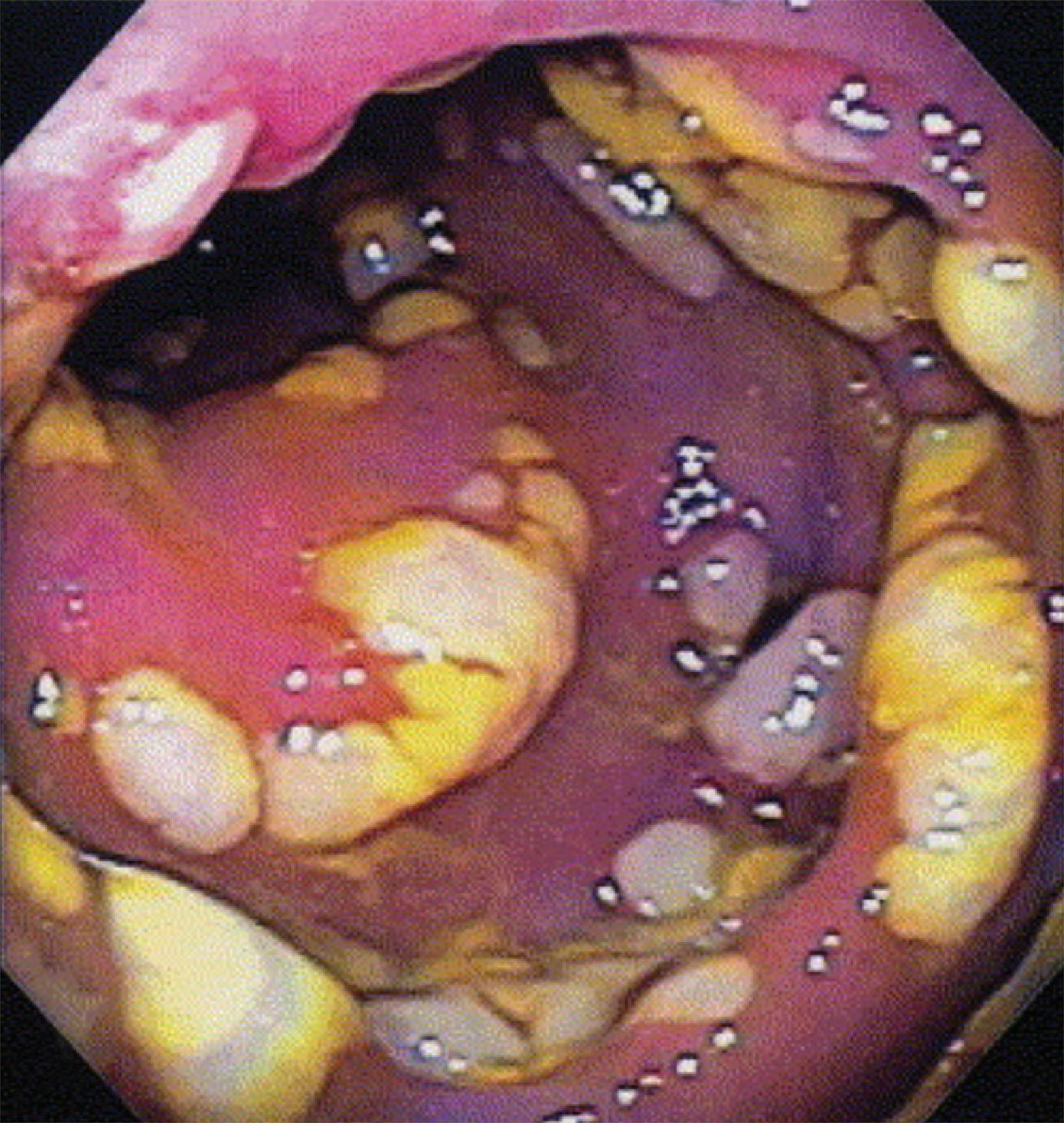 FIG. 1, Endoscopic appearance of pseudomembranes.