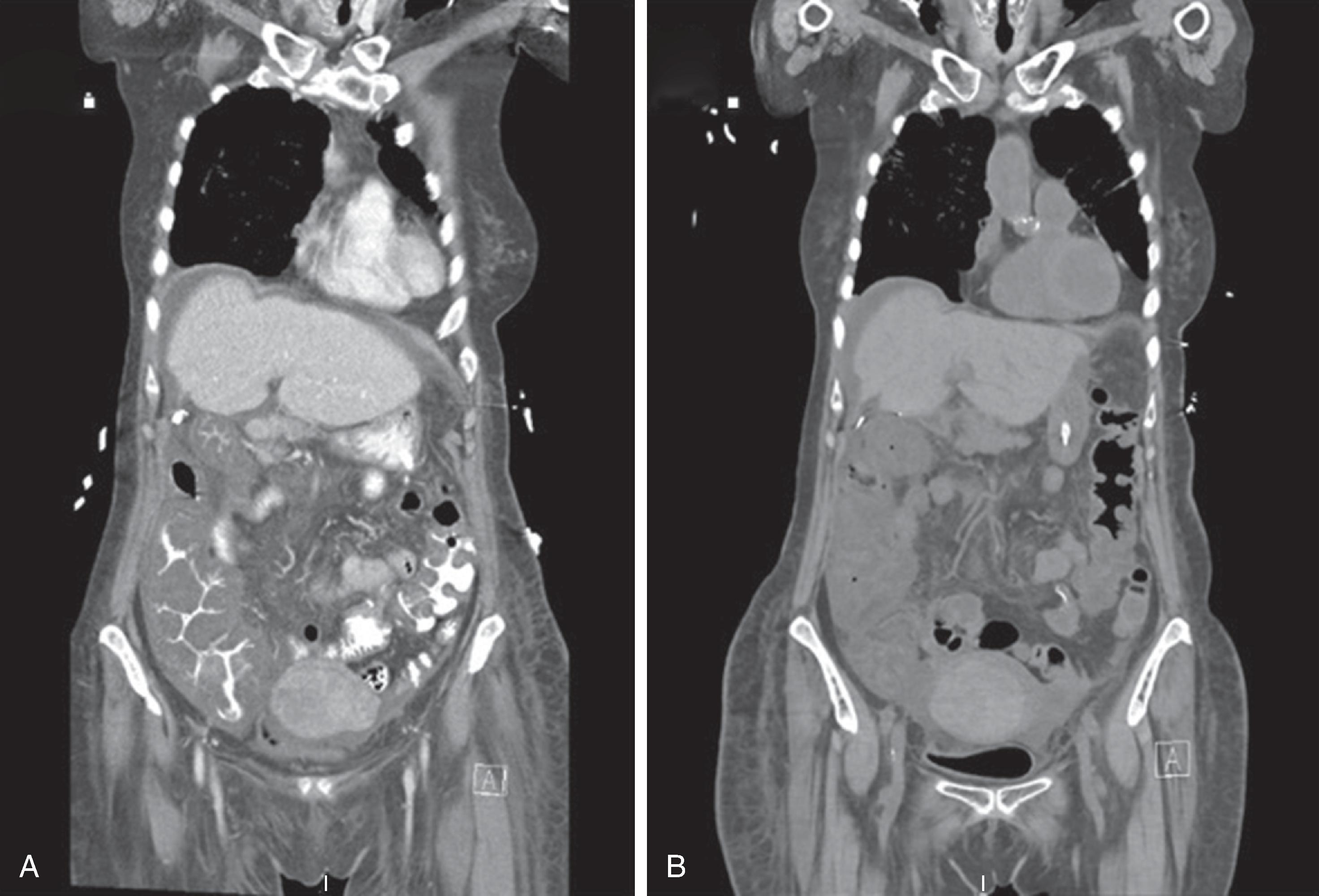 FIG. 2, Computed tomography scan showing fulminant Clostridioides difficile infection, with ( A ) and without ( B ) contrast.