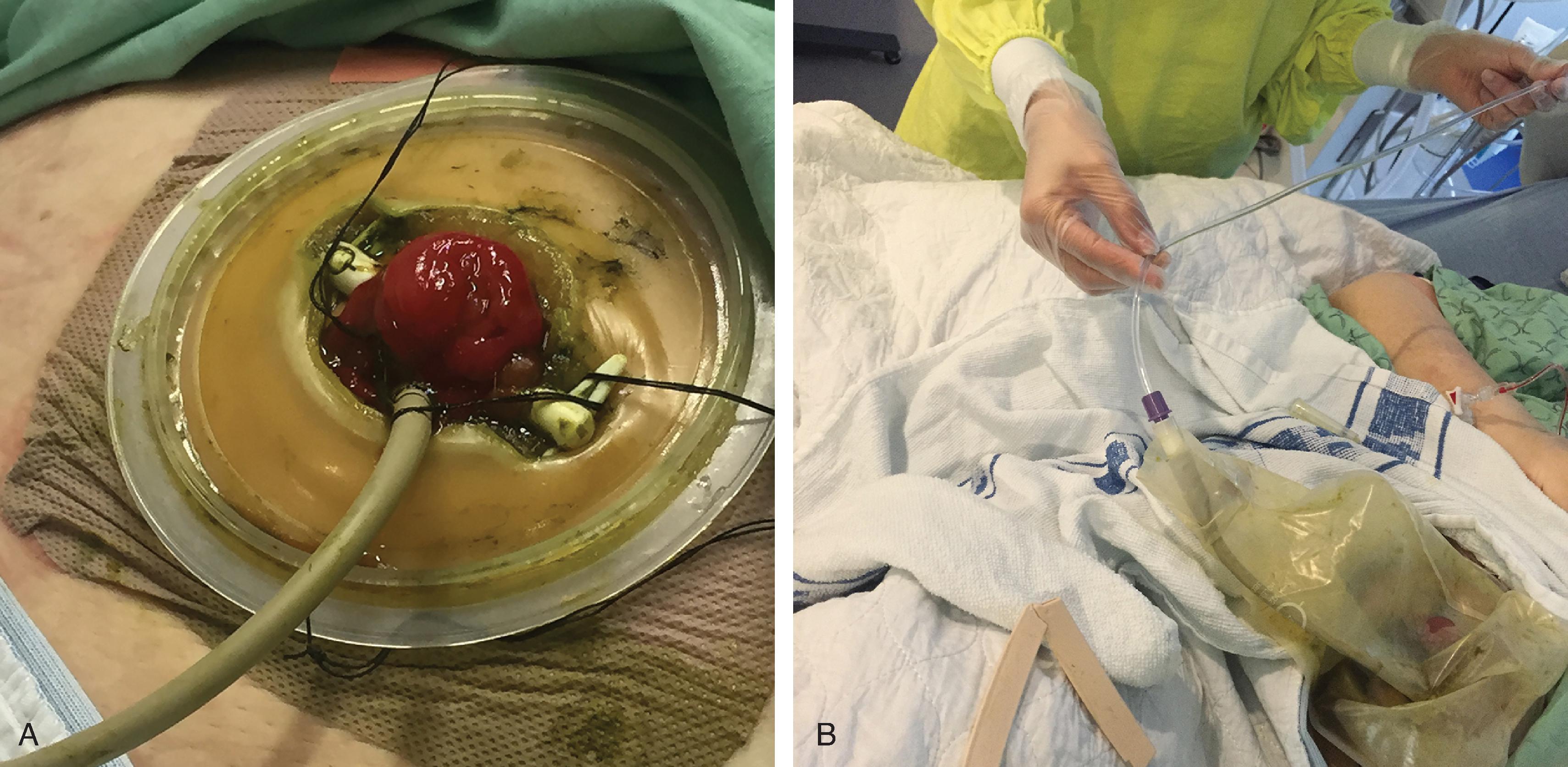 FIG. 3, Example of set-up for diverting loop ileostomy and colonic lavage . (A) Foley catheter inserted into distal limb of the ileostomy, sutured to the rod. (B) Feeding access tubing used to administer vancomycin flushes.