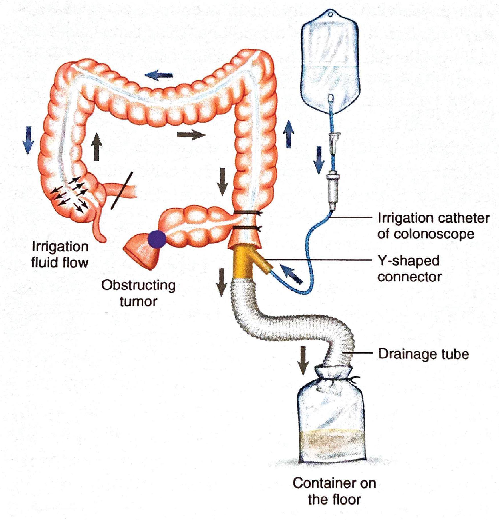 FIG. 2, Alternative colonic lavage using a Y-shaped connector.