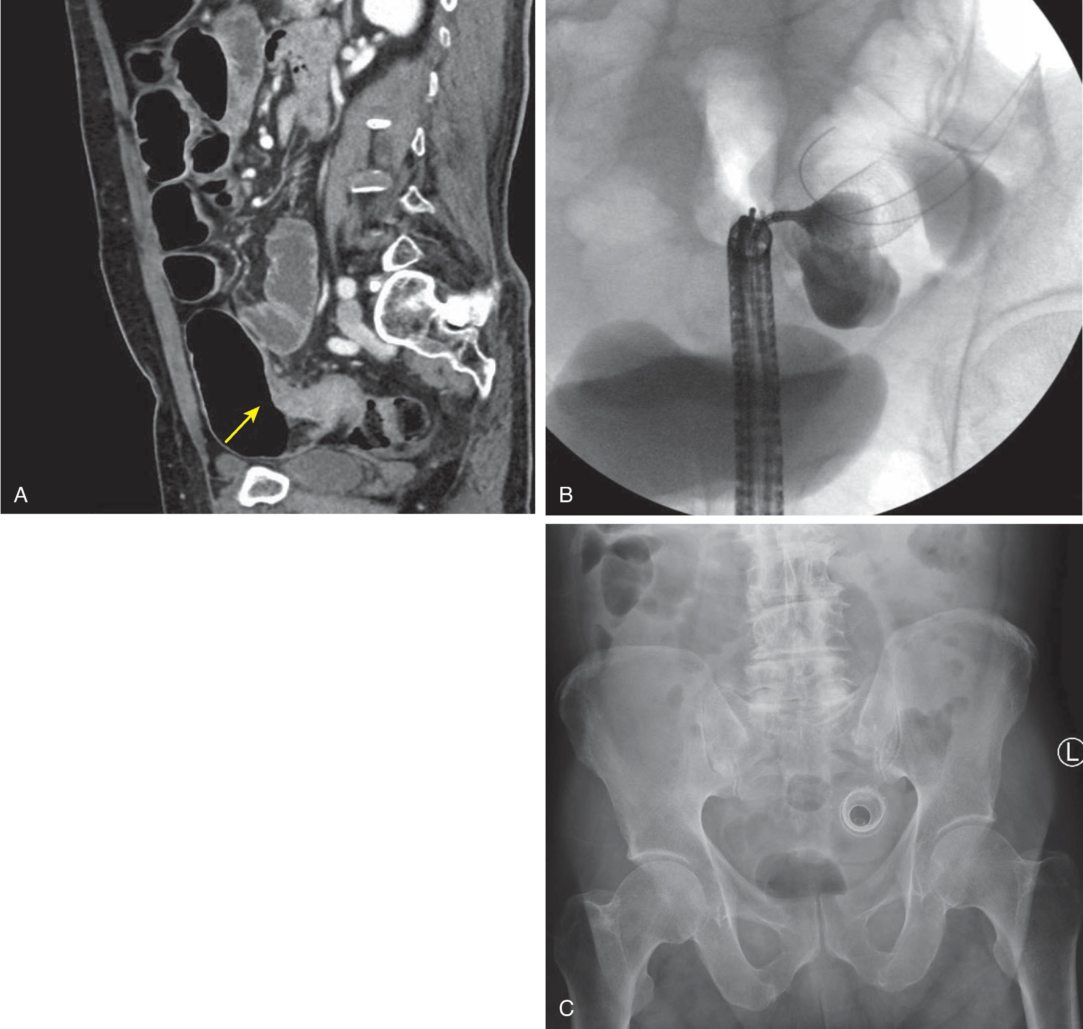 FIG. 3, Endoscopic stent placement for obstructing rectosigmoid cancer. (A) Arrow indicates obstructing pelvic lesion. (B) Fluoroscopic-guided passage of the wire. Note the obstructing lesion. (C) Poststent abdominal film with improvement of large bowel distension.