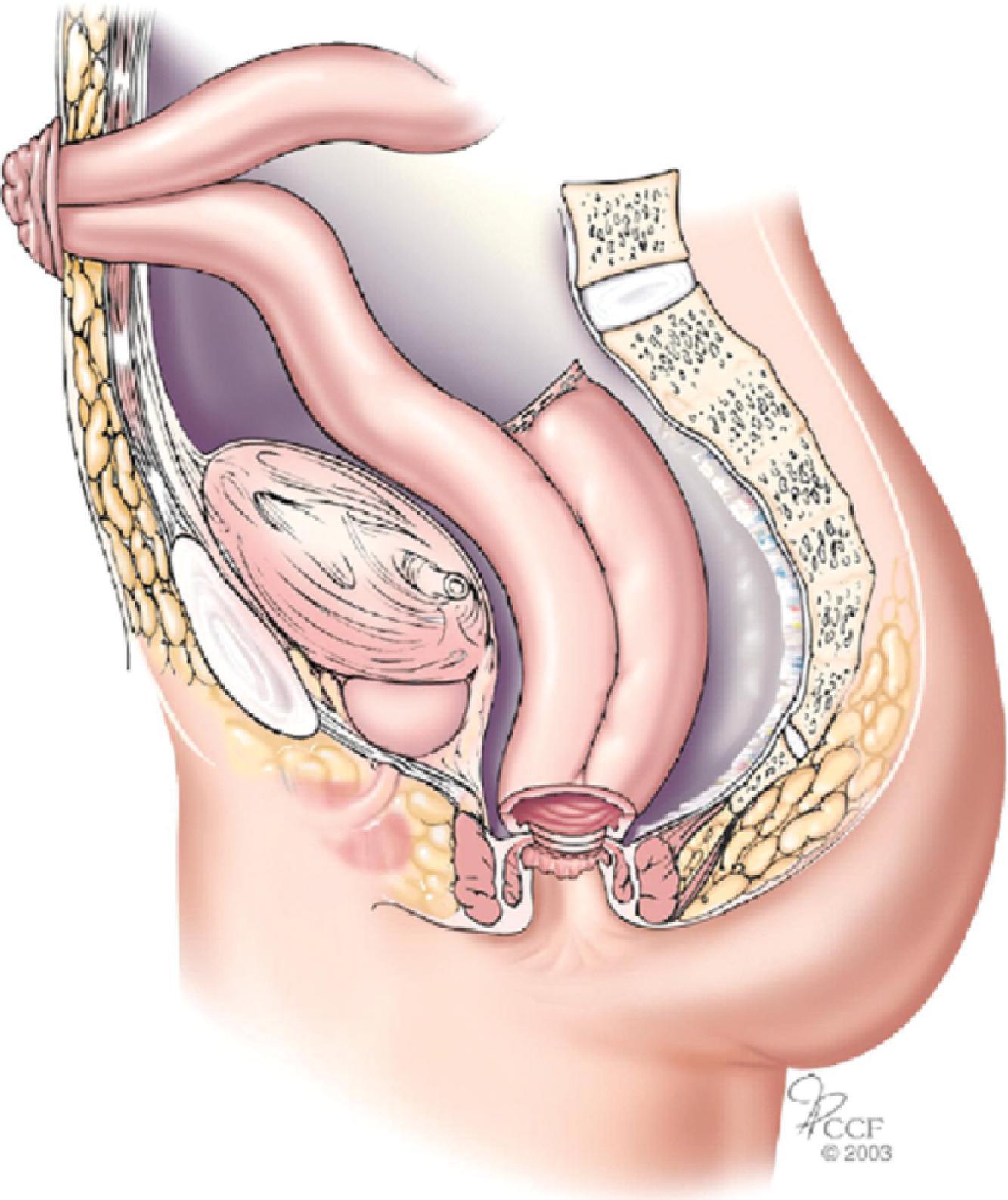 FIG. 1, Ileal pouch anal anastomosis in place with diverting loop ileostomy.