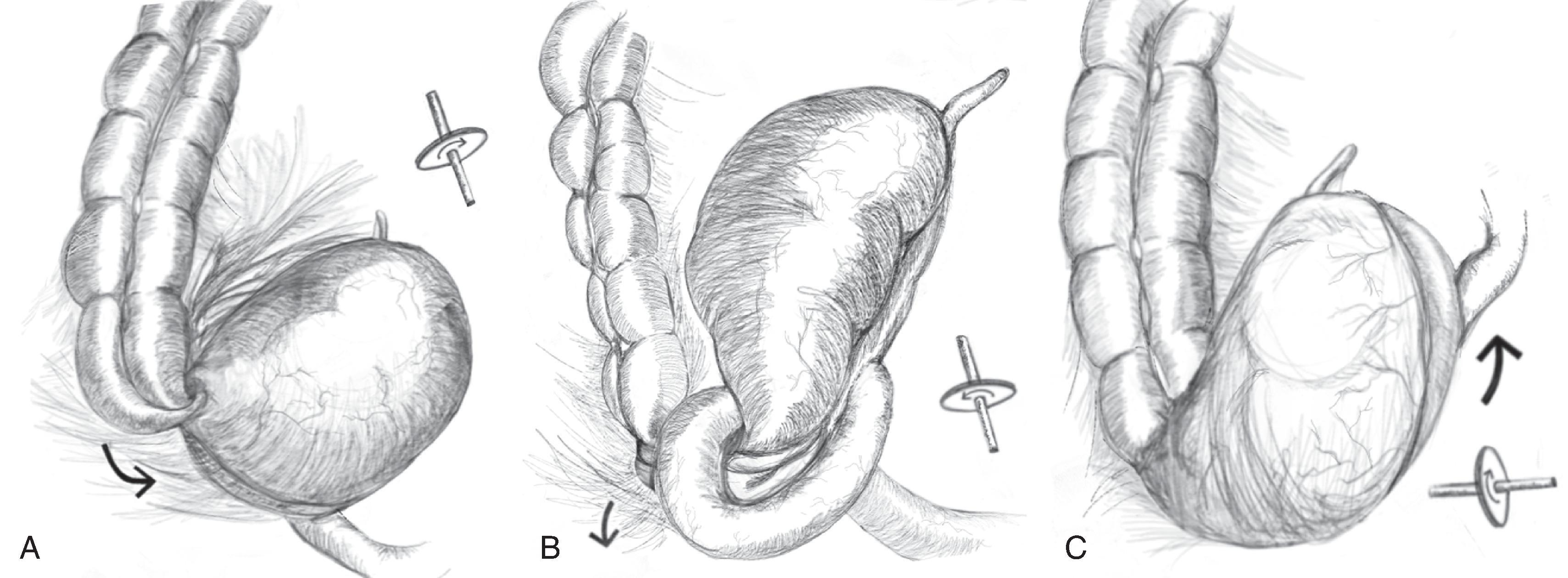 FIG. 4, Types of cecal volvulus. (A) Type 1, axial cecal volvulus. (B) Type 2, loop cecal volvulus. (C) Type 3, cecal bascule.