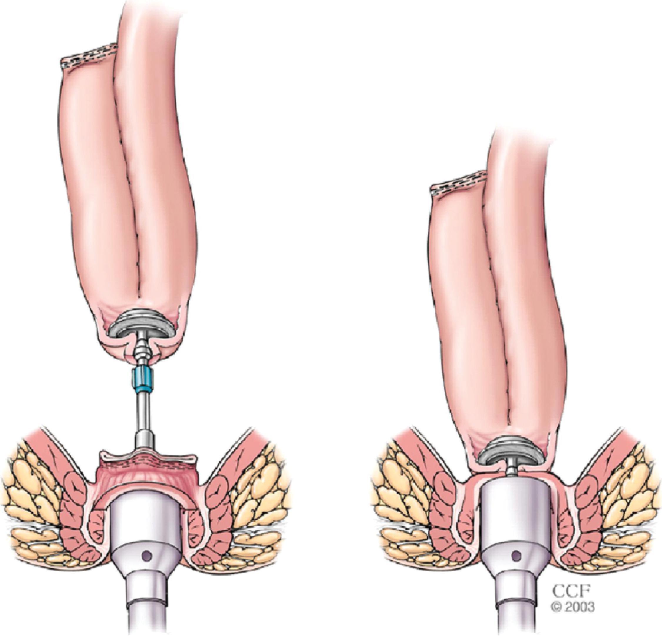 FIG. 2, Ileal pouch anal anastomosis creation using a circular stapler.