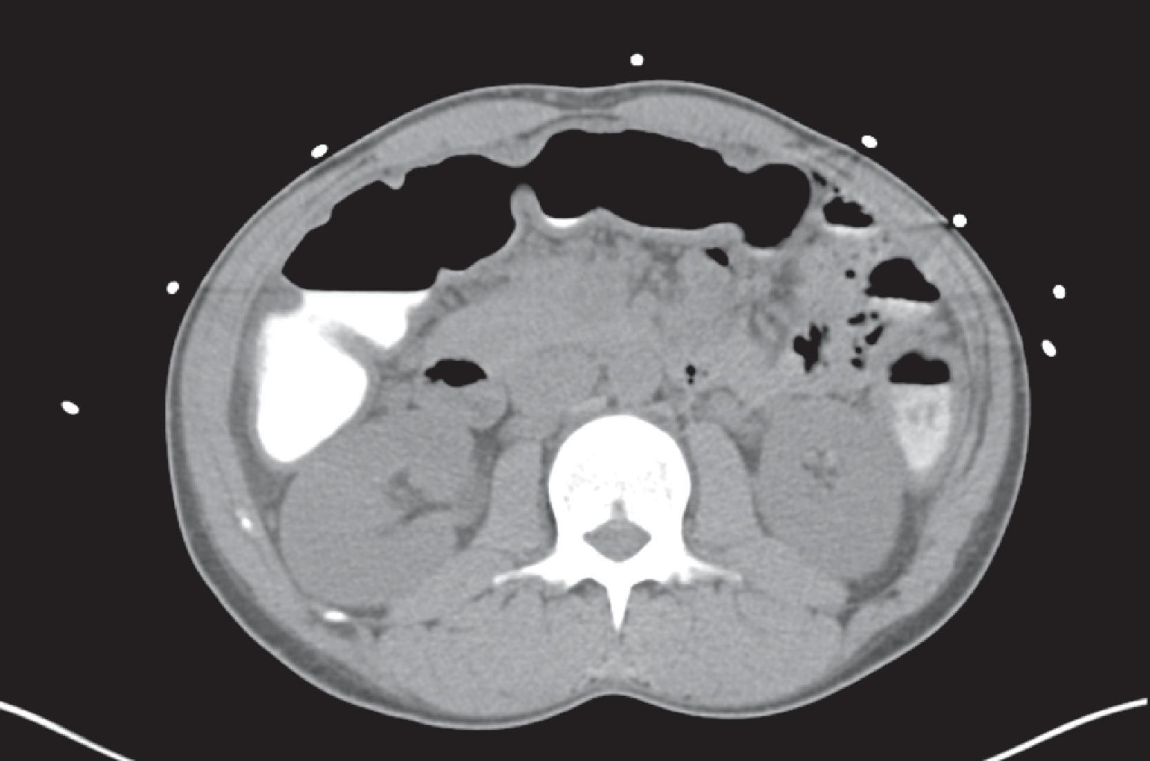 FIG. 1, Computed tomography scan of the abdomen showing dilated and thickened wall of the colon.