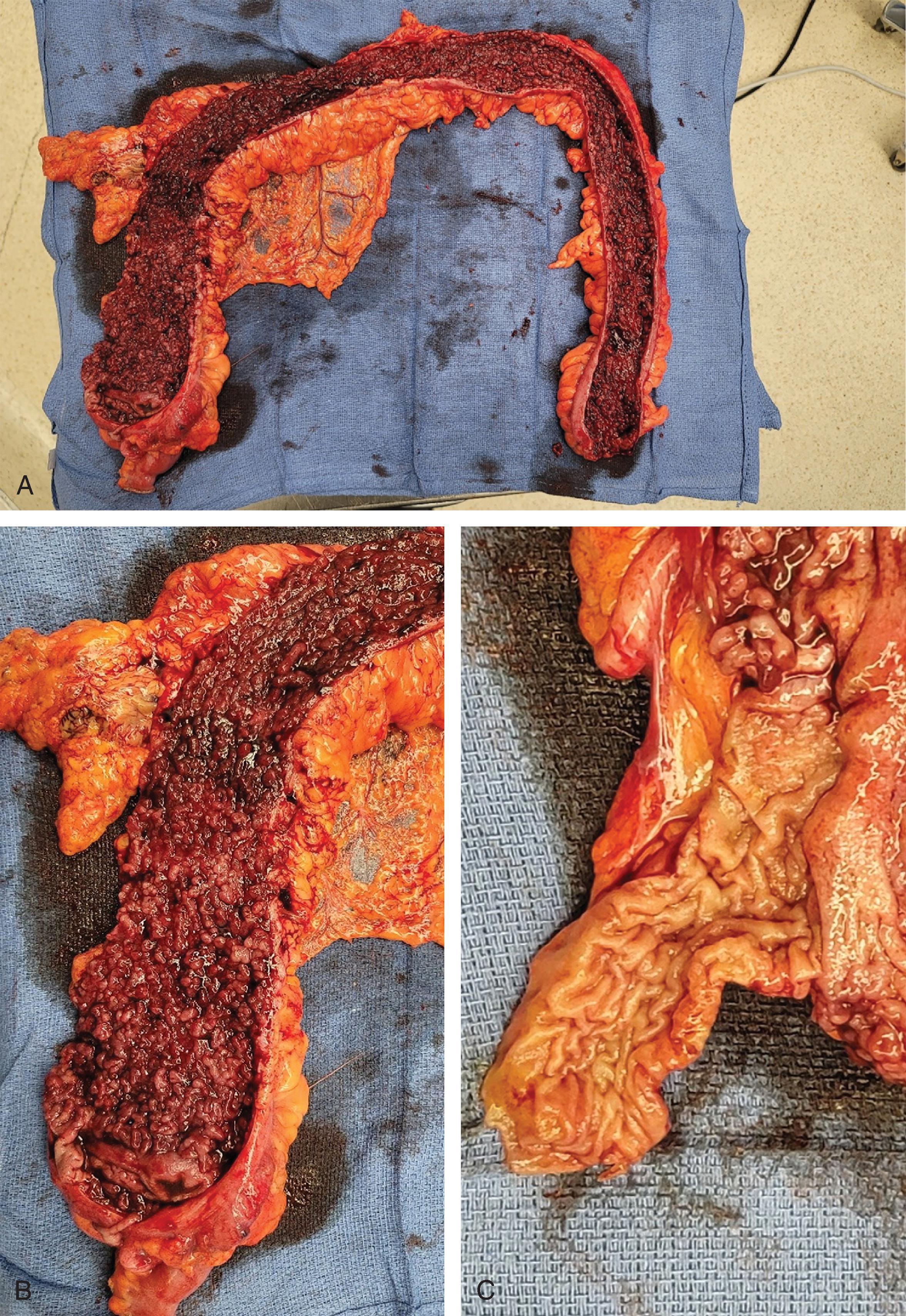 FIG. 1, Mucosal appearance of CC. (A) Entire colon is involved on a TAC specimen. (B) Extensive mucosal cobblestoning is present. (C) Normal-appearing terminal ileum.