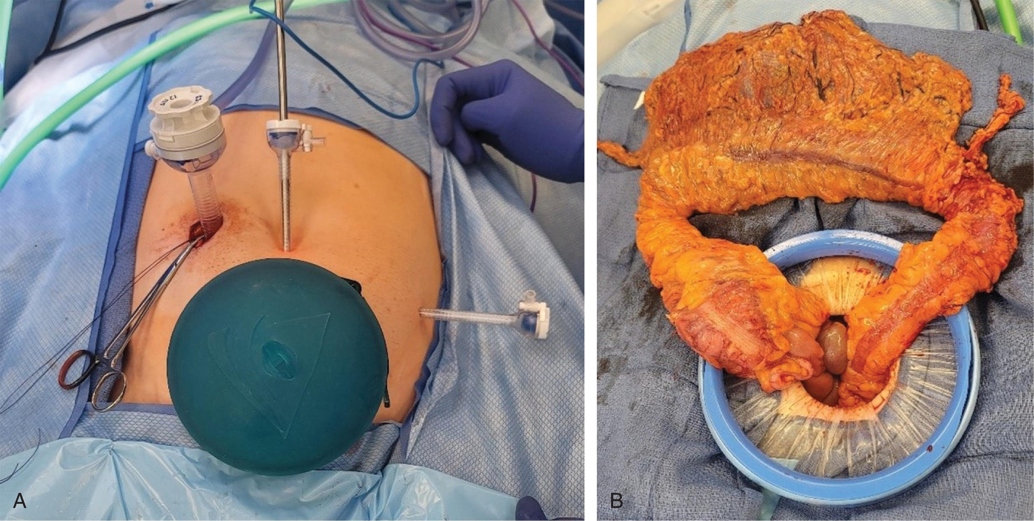 FIG. 2, Hand-assisted laparoscopic TAC. (A) 5-mm umbilical laparoscope port for the camera, 12-mm right working port at the site of the future stoma (this is also the entry site), 5-mm left lateral assistant port, Pfannenstiel incision for hand assist and specimen extraction. (B) The entire colon is externalized through the Pfannenstiel incision.