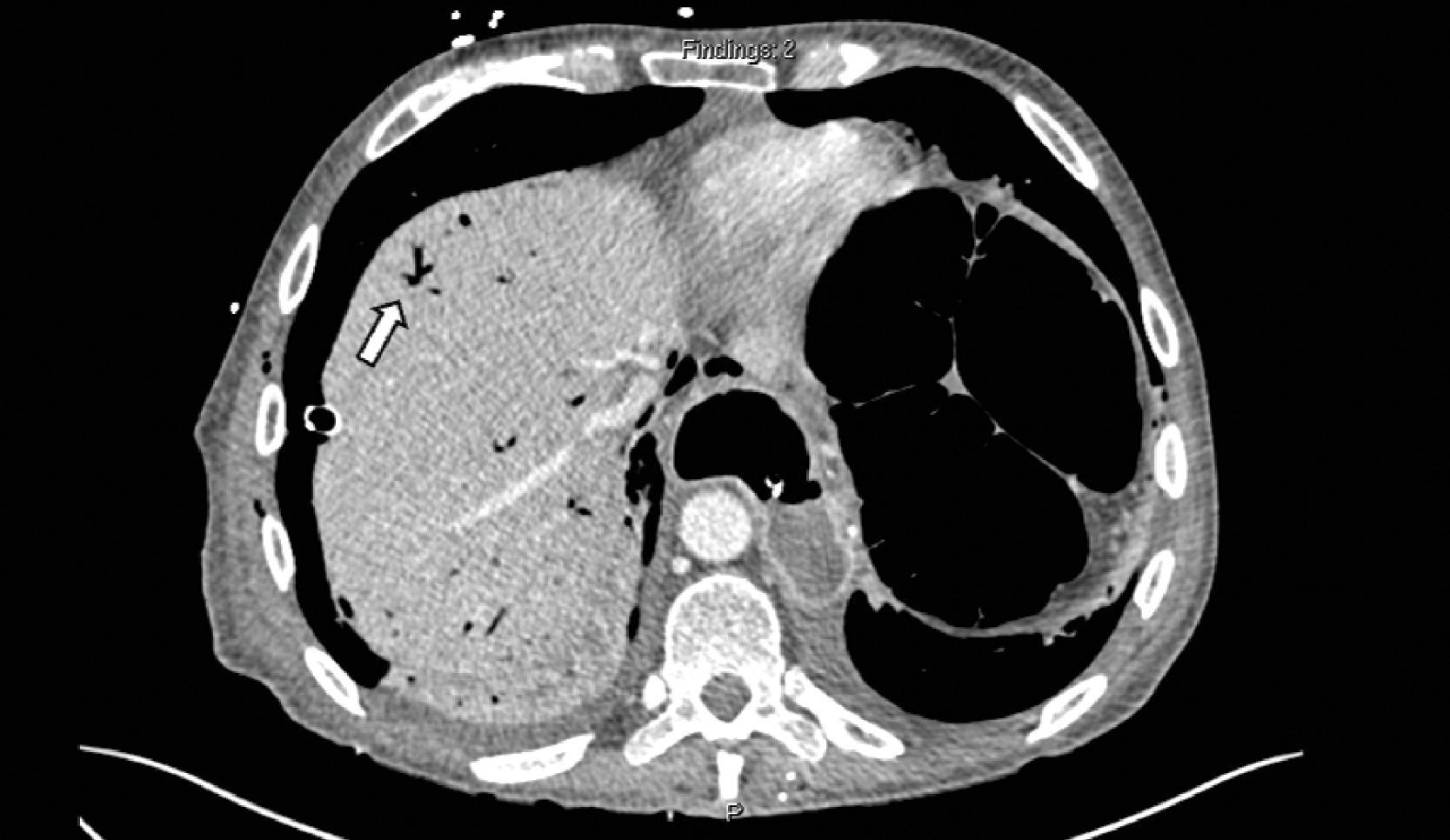 FIG. 2, Contrast enhanced axial CT image demonstrating foci of gas in the portal veins (arrow). Peripherally branching air on CT helps differentiating portal venous gas from pneumobilia, which typically is more central. Significant bowel distention is also noted.
