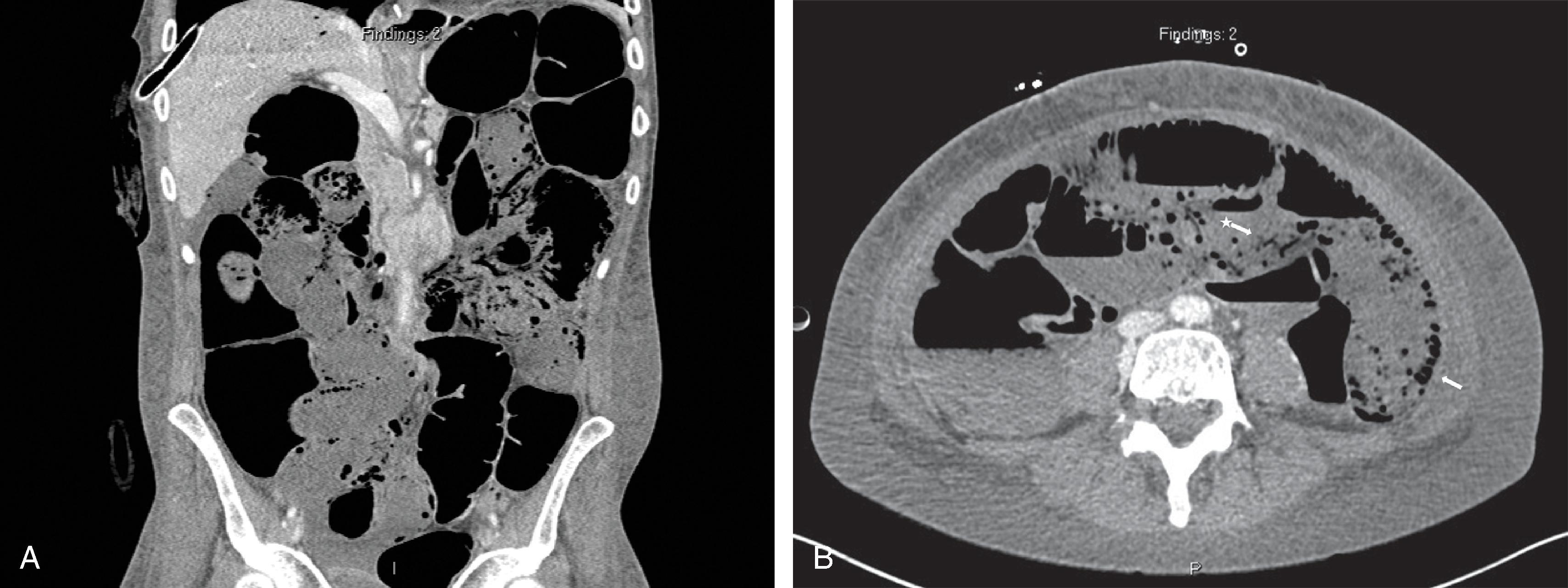 FIG. 3, A and B , Contrast enhanced axial CT image showing extensive dilatation and pneumatosis (arrow) of the small bowel. Pneumatosis was also seen in the cecum, corresponding to the superior mesenteric artery vascular tract. Mesenteric venous gas is noted as well (arrow with *).