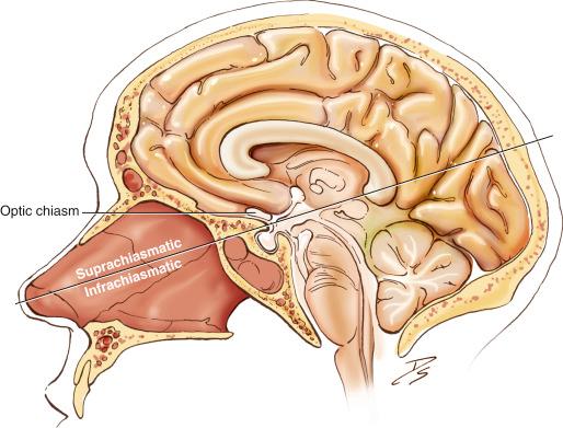 Fig. 31.1, Suprachiasmatic and infrachiasmatic lesions.