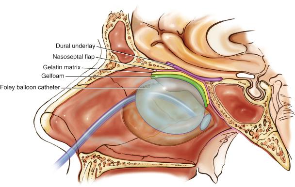 Fig. 31.4, Note the layers of the reconstruction: Dural underlay, nasoseptal flap, gelatin matrix, Gelfoam, Foley balloon catheter.