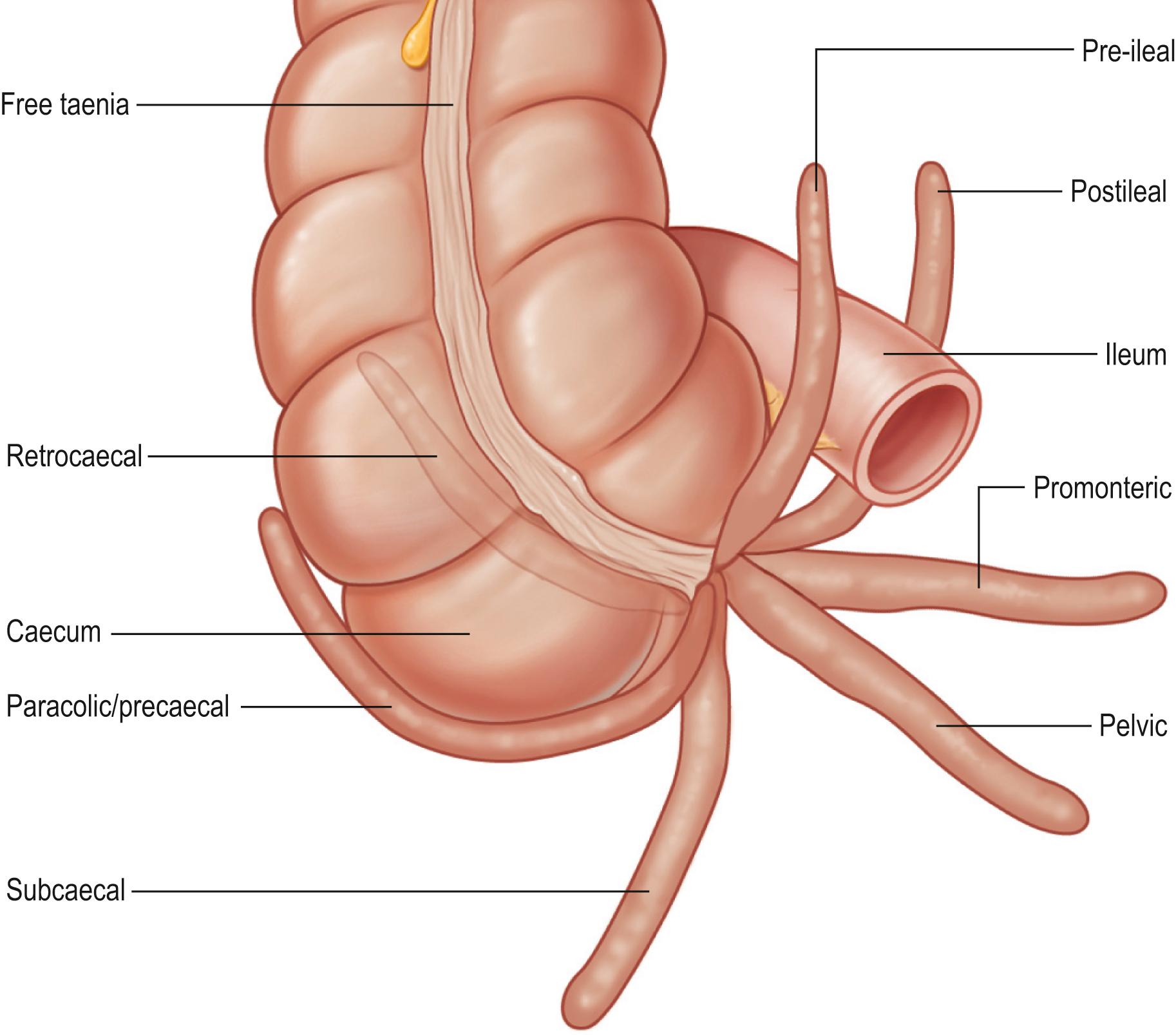 Fig. 65.19, The major positions of the appendix encountered at surgery or post mortem.