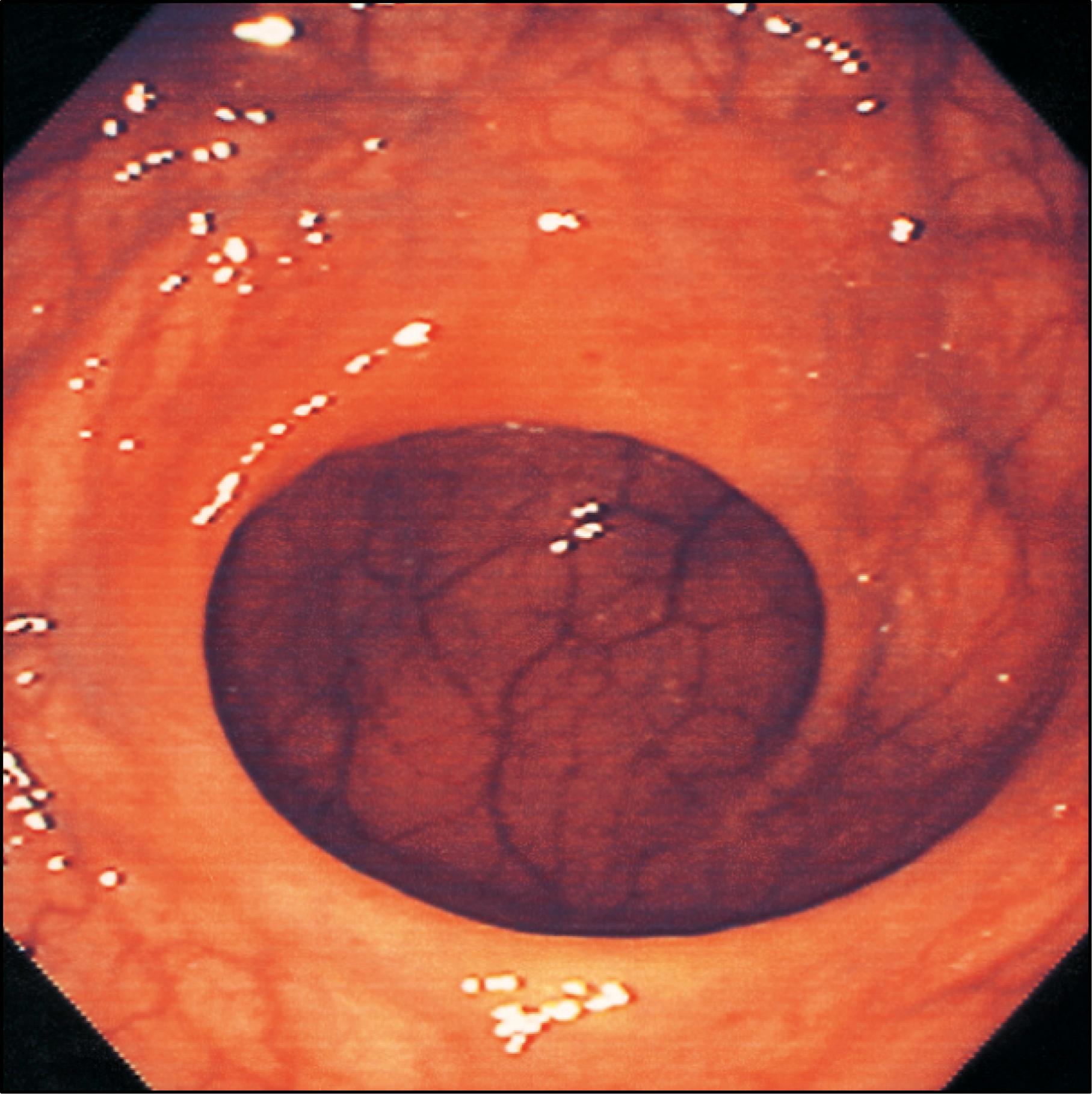 Fig. 65.10, The endoscopic appearance of the rectum: note the large transverse folds, with little else in the way of mucosal folds, which characterize the rectum. Prominent submucosal vessels are often seen, particularly in the distal third.