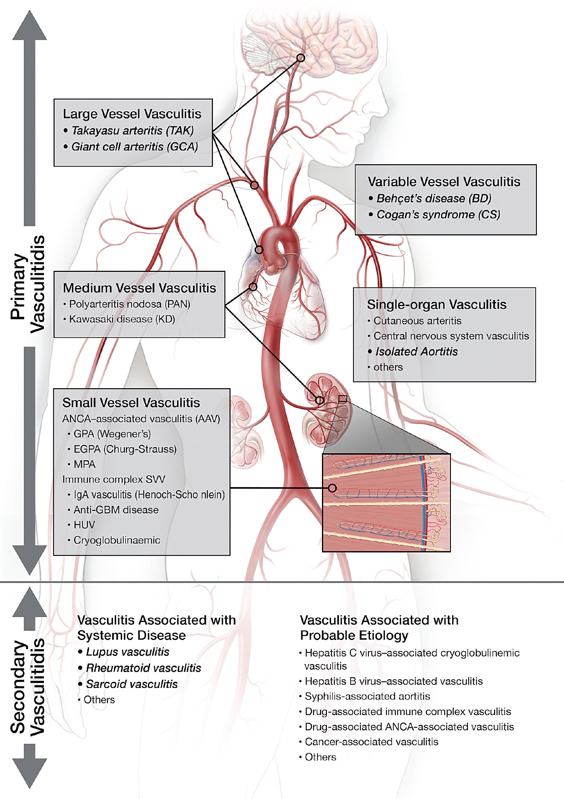 Large Vessel Vasculitis Clinical Tree