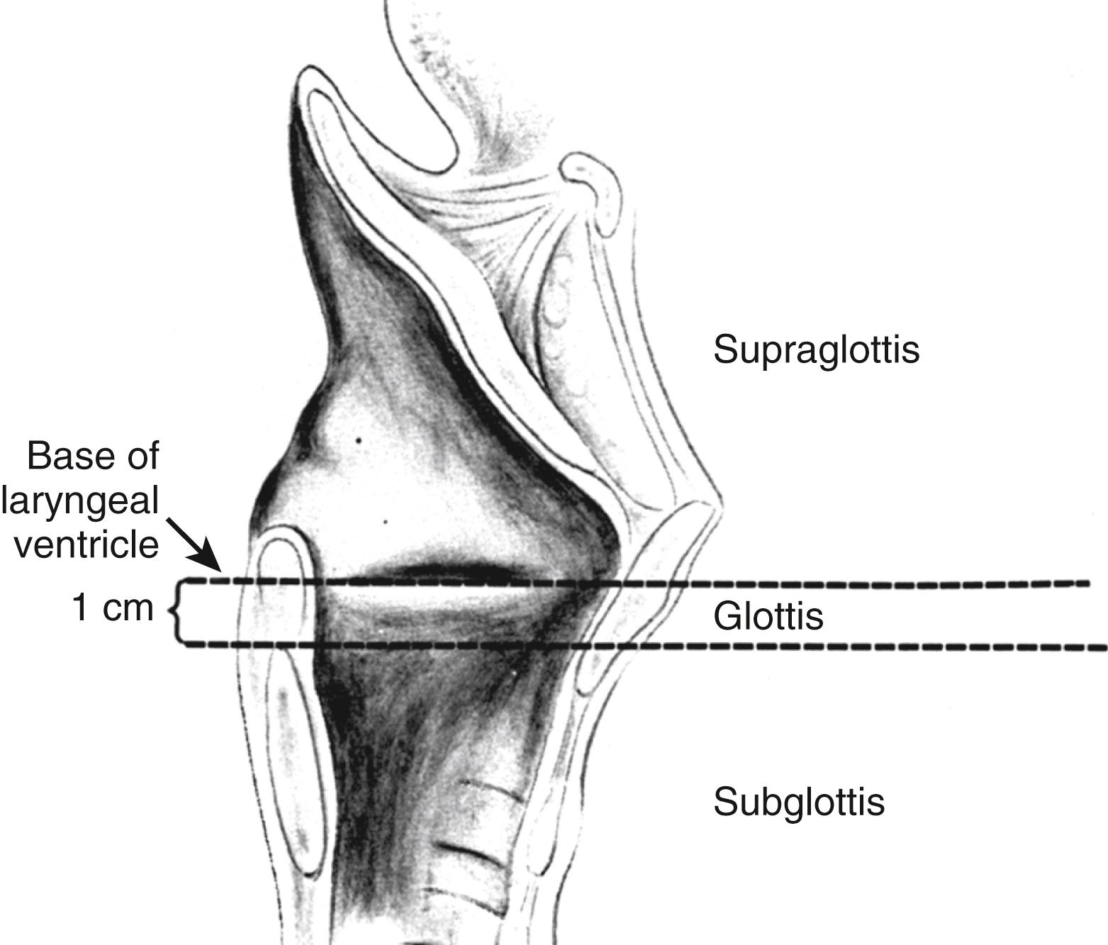 Fig. 8.1, Sagittal drawing of the larynx depicting the three anatomic areas. The glottic larynx extends from the free edge of the true vocal cord inferiorly 1 cm. This approximates the histologic observation of stratified squamous epithelium on the glottis changing to respiratory epithelium of the subglottis.