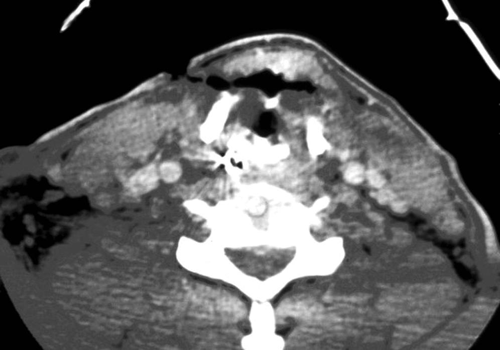 Fig. 8.3, This open laryngeal injury (gunshot wound) requires emergent establishment of a tracheostomy and then comprehensive repair of both mucosa and framework trauma.